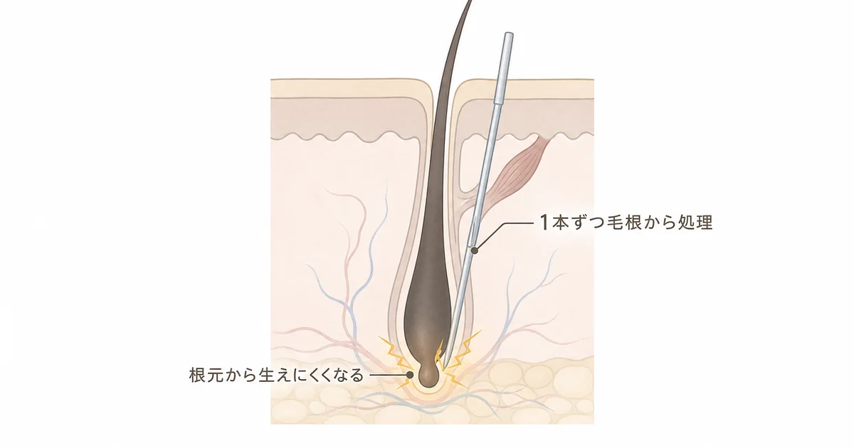 メンズTBCの美容電気脱毛が毛根から処理する仕組みの図解
